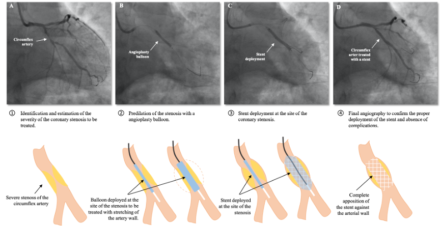 Angioplasty of the circumflex artery