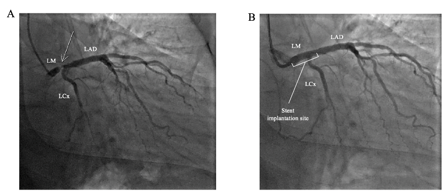 Example of a distal left main angioplasty
