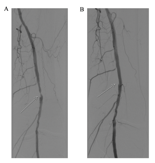 Angioplasty of a distal superficial femoral artery