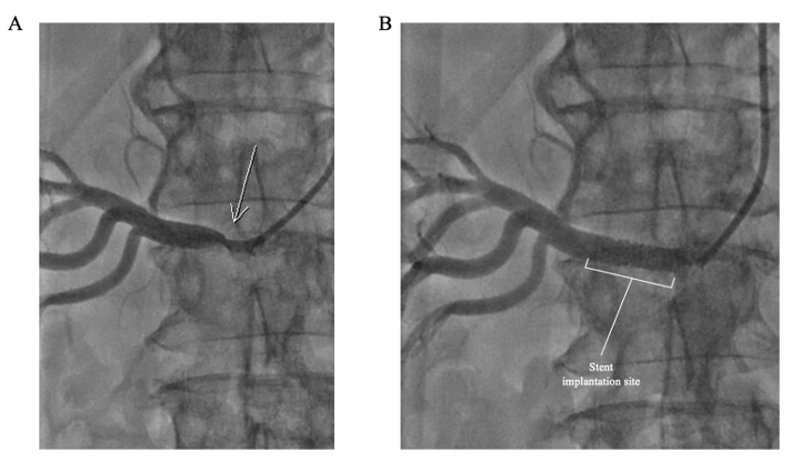 Example of a right ostial renal artery angioplasty