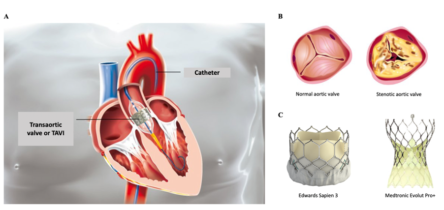 Transcatheter Aortic Valve Implantation Tavi Centre De Cardiologie