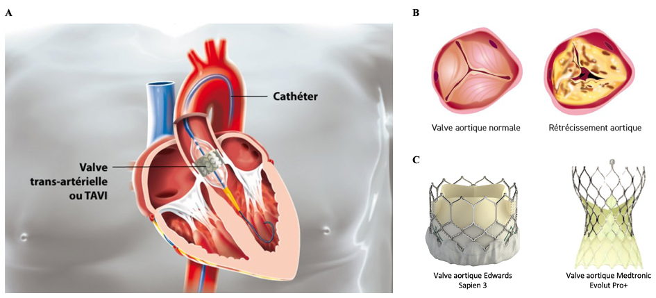 Remplacer une valve cardiaque par sonde, une technique efficace - Sciences  et Avenir