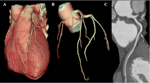 Example of coronary CT